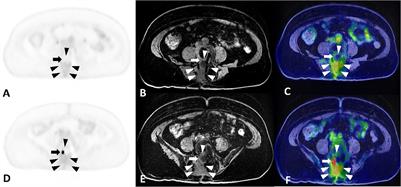 Case Report: Nerve Root Entrapment Due to Epidural Fibrosis in a Patient With Failed Back Surgery Syndrome: Value of 2-18F-Fluorodeoxyglucose Simultaneous Positron Emission Tomography-Magnetic Resonance Imaging